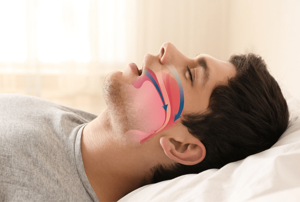 Webinar GRÁTIS - Atuação Terapêutica nas Disfunções Respiratórias do Sono